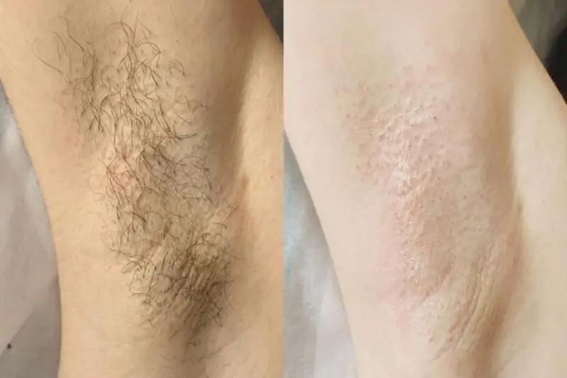 Triệt lông nách có thể mọc lại nhưng thưa và mảnh hơn