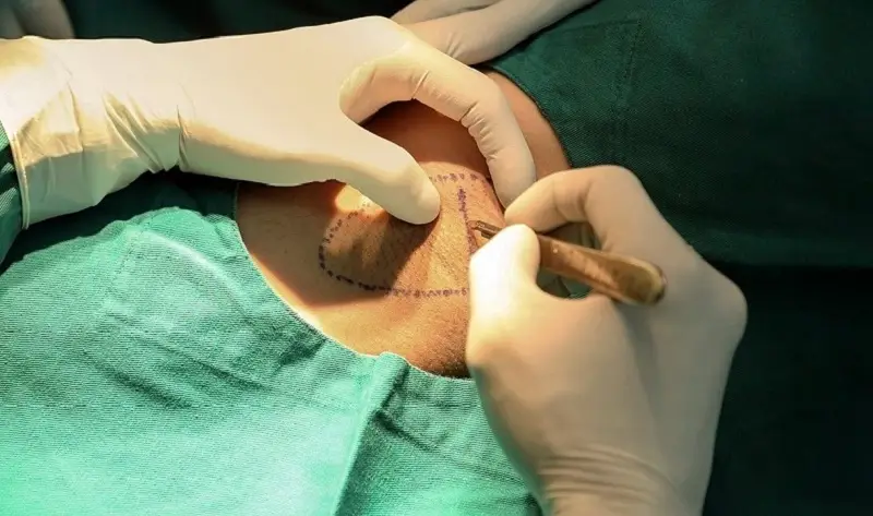 Có thể trị hôi nách bằng phẫu thuật