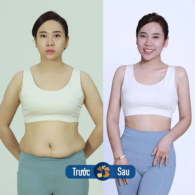 ảnh trước và sau của khách hàng giảm mỡ lipo
