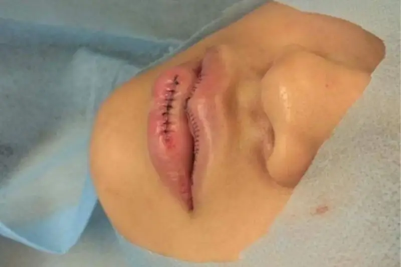 Khắc phục bằng phẫu thuật