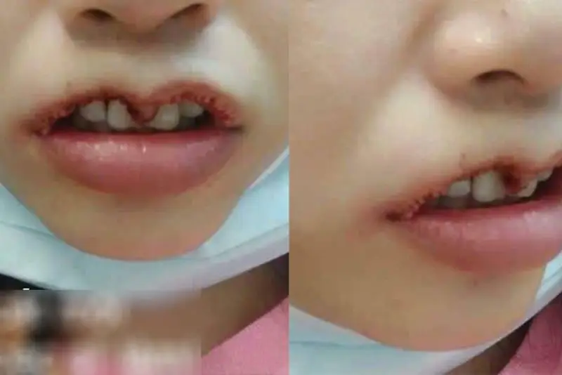 Cắt môi trái tim bị hở răng là biến chứng sau phẫu thuật