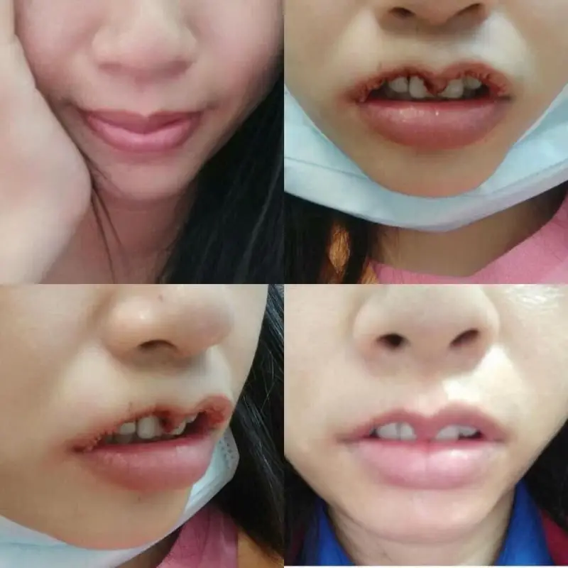 Lộ răng cửa sau khi cắt môi tim là biến chứng khá nghiêm trọng