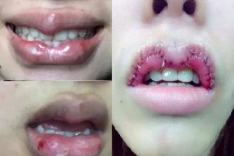 Cắt môi bị hỏng có dấu hiệu sưng, lở loét