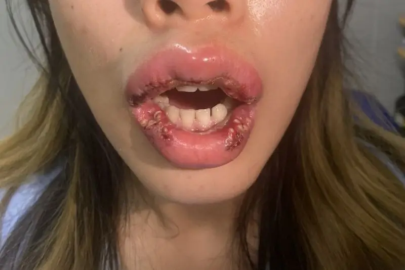 Nhiễm trùng là biến chứng khi cắt môi sai kỹ thuật