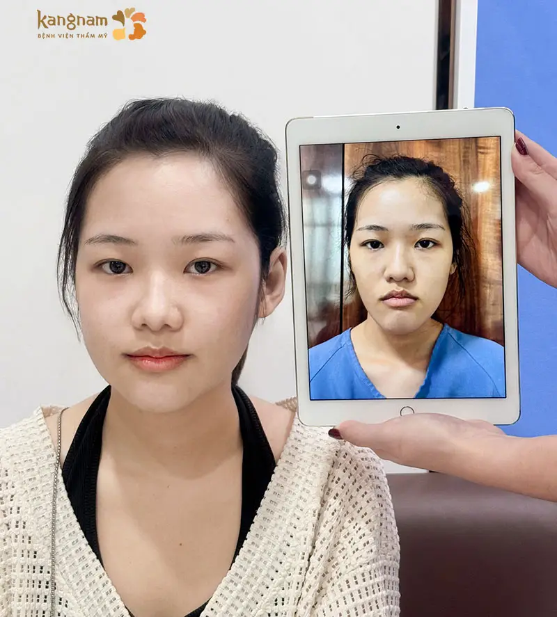 Khách hàng sau khi phẫu thuật hàm móm tại Kangnam