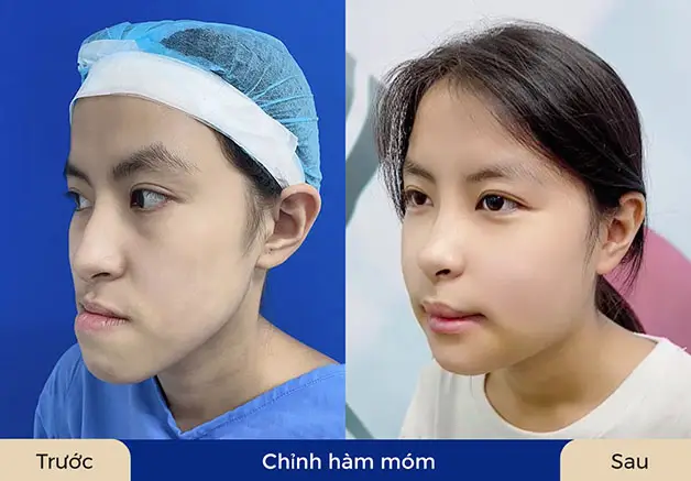 Hàm móm cần can thiệp phẫu thuật mới có hiệu quả