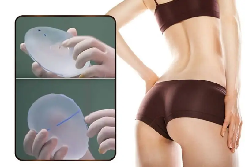 Đặt túi nâng mông duy trì được hiệu quả lâu dài