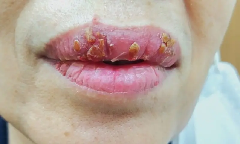 Tình trạng môi sưng to, phồng rộp, màu môi không đều