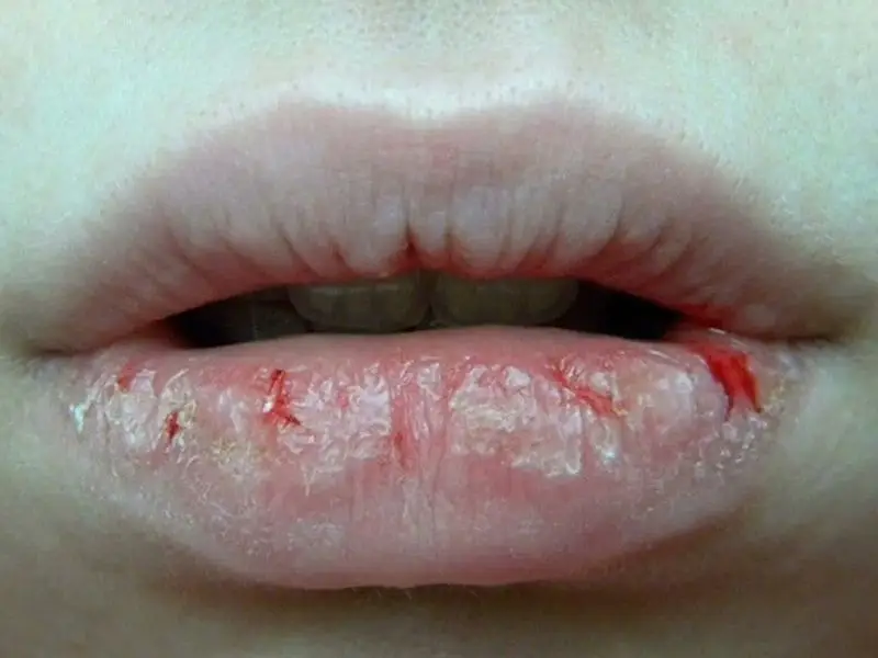 Môi bị ngứa ngáy, chảy máu, bong da hoặc lên mủ