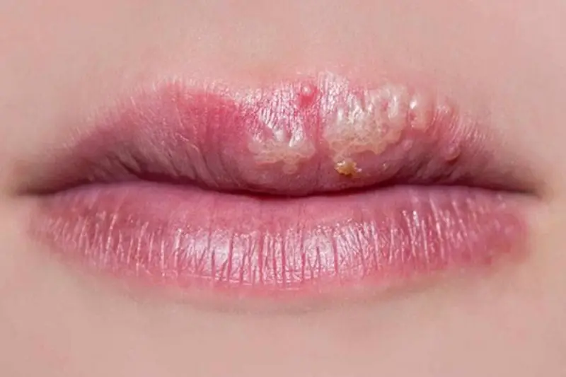 Dấu hiệu phun môi không thành công là môi xuất hiện các nốt mụn nước