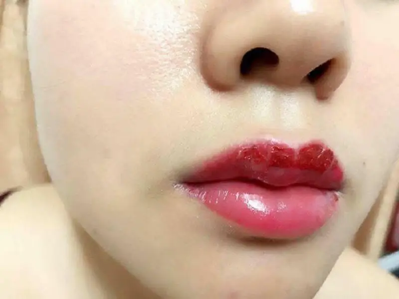 Tình trạng môi đau nhức, sưng tấy sau phun môi