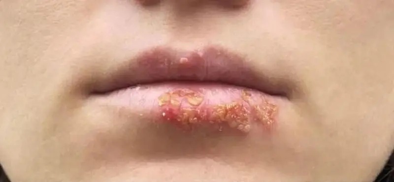 Các nốt mụn sau đó vỡ ra gây đau nhức