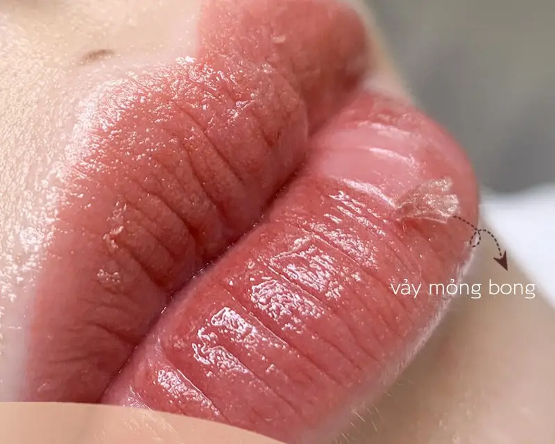 Vảy môi bong nhẹ hoặc mới chỉ tạo vảy