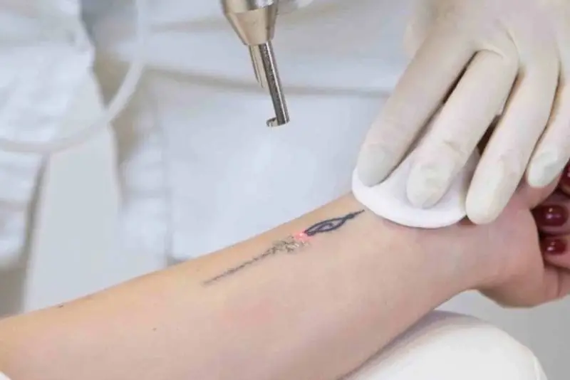 Xóa xăm nên thực hiện khi da đã ổn định từ lần xăm trước đó
