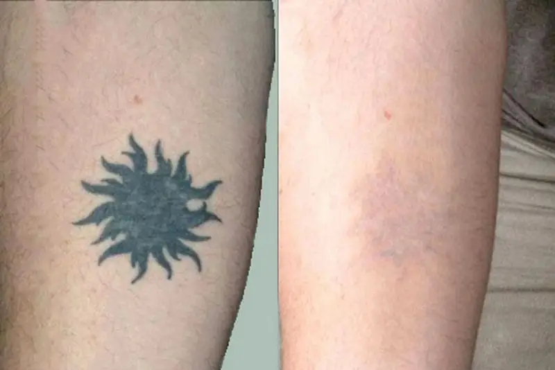 Sau khi xăm hình không nên xóa ngay