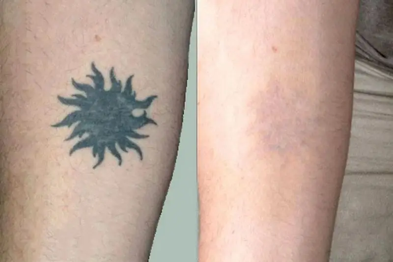 Vùng mắt cá chân thường khó xóa hình xăm hơn