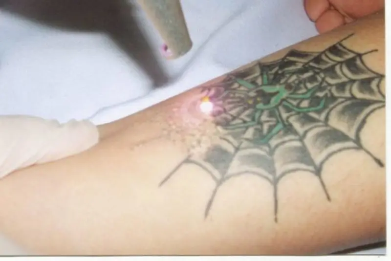 Hình xăm mới có thể xóa được