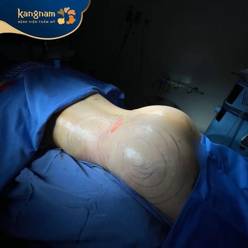 Hút mỡ nâng mông giúp tạo vòng 3 to tròn, cân đối tự nhiên