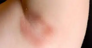 Kích ứng do triệt lông sai cách