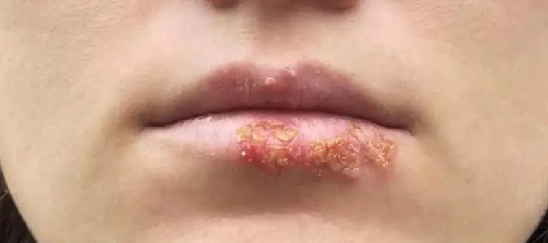 Mụn nước sau phun môi do virus phát triển và gây ra các nốt mụn 