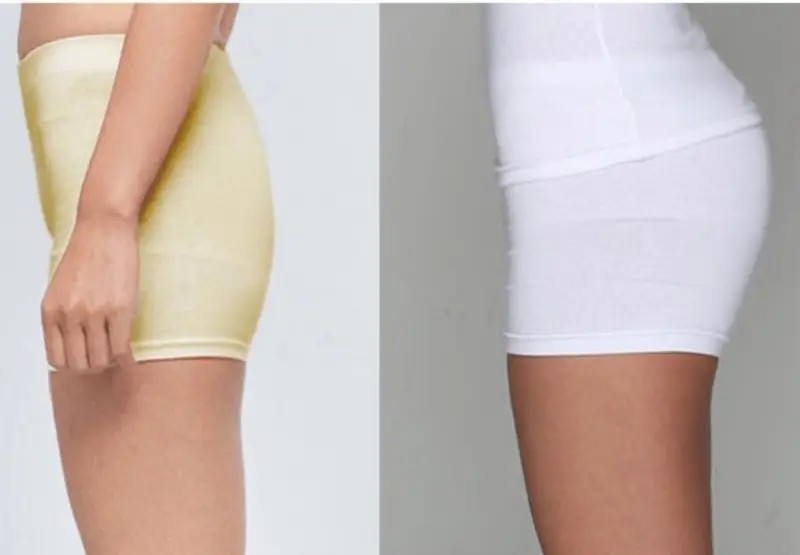 Nâng mông bằng tiêm filler không cần dao kéo