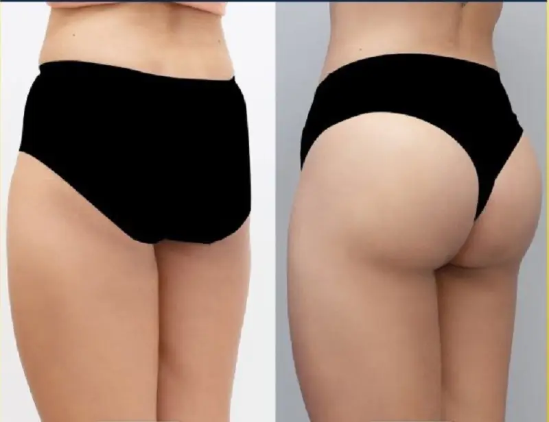 Dáng mông tự nhiên, cân đối sau nâng mông đặt túi