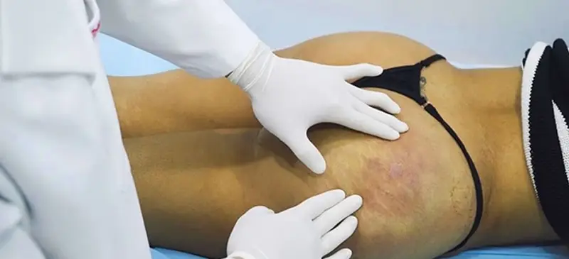 Túi độn nâng mông xảy ra biến chứng sau thực hiện