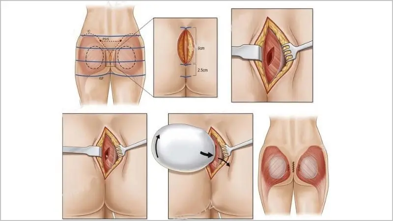 Phương pháp nâng mông đặt túi độn