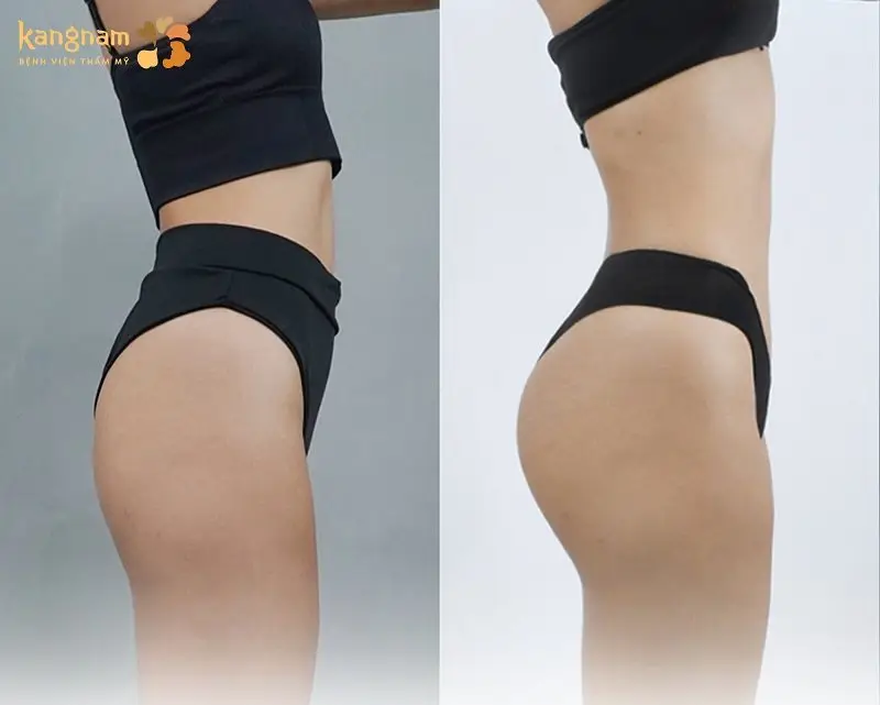 Tùy vào tình trạng khuyết điểm vùng mông của mỗi khách hàng