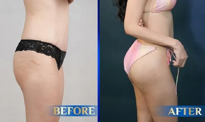 Tuân thủ theo hướng dẫn của bác sĩ sẽ giúp chị em sở hữu vòng 3 to tròn, cân đối như ý