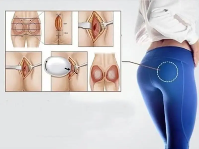 Nâng mông nội soi giúp tạo vòng 3 to tròn, quyến rũ