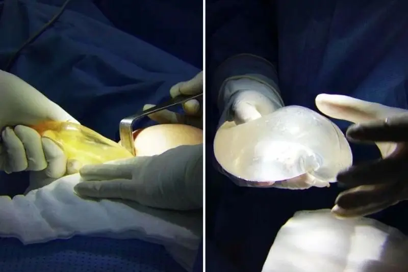 Giá nâng ngực ở Bệnh viện Chợ Rẫy tùy thuộc vào tình trạng cụ thể và nhu cầu của mỗi khách hàng