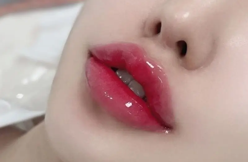 Cấy môi sinh học giúp đôi môi trẻ trung, căng bóng nhưng thời gian duy trì ngắn