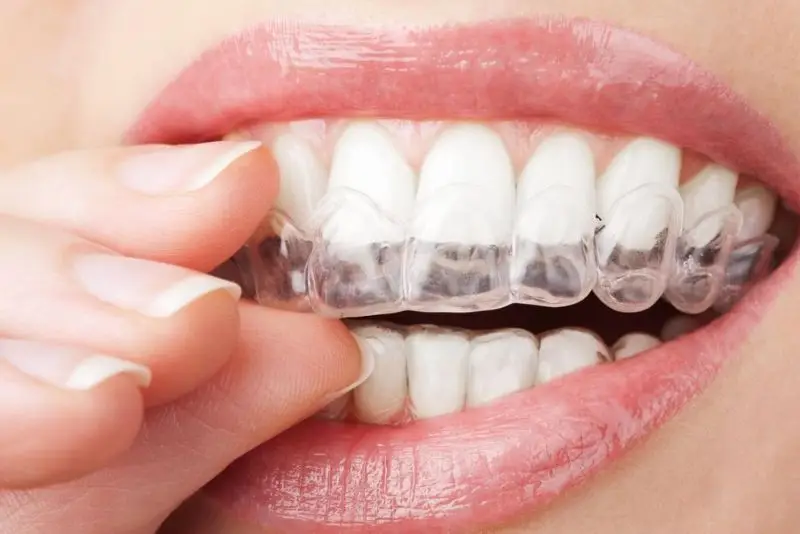 Niềng răng bằng khay trong suốt có tính thẩm mỹ cao