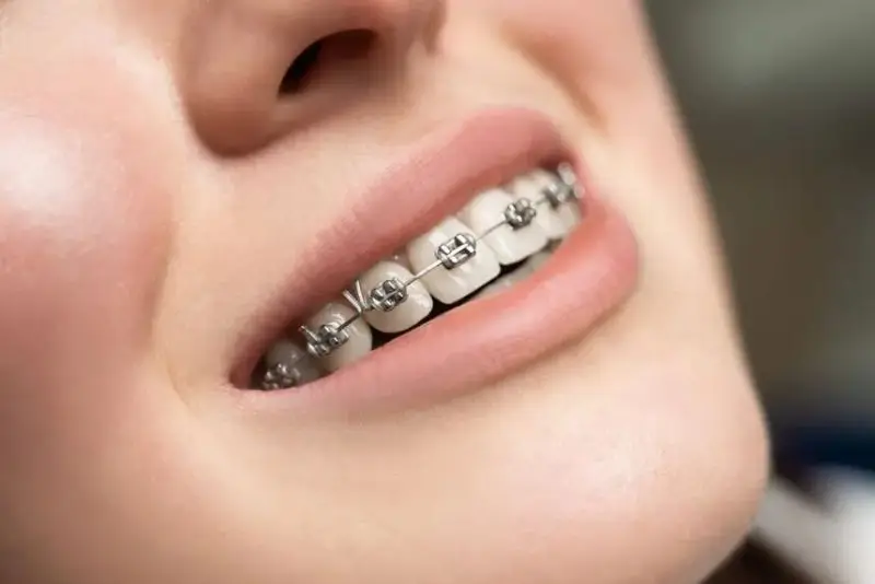 Niềng răng chỉ khắc phục móm do răng