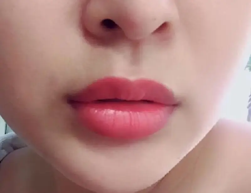 Phun môi bị sưng là tình trạng thường gặp và sẽ hết sau vài ngày