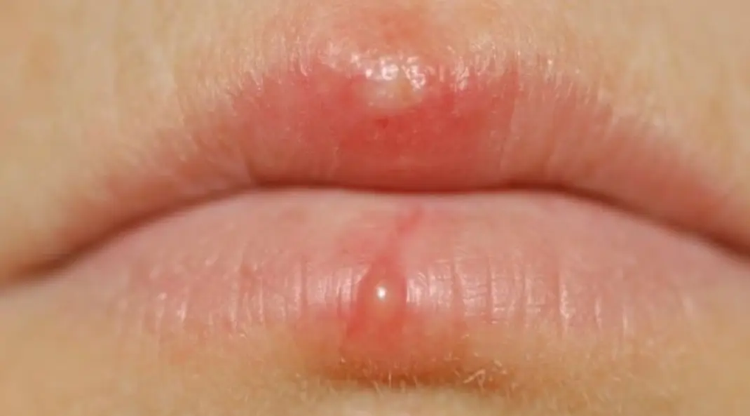 Môi nổi mụn nước sau khi phun môi