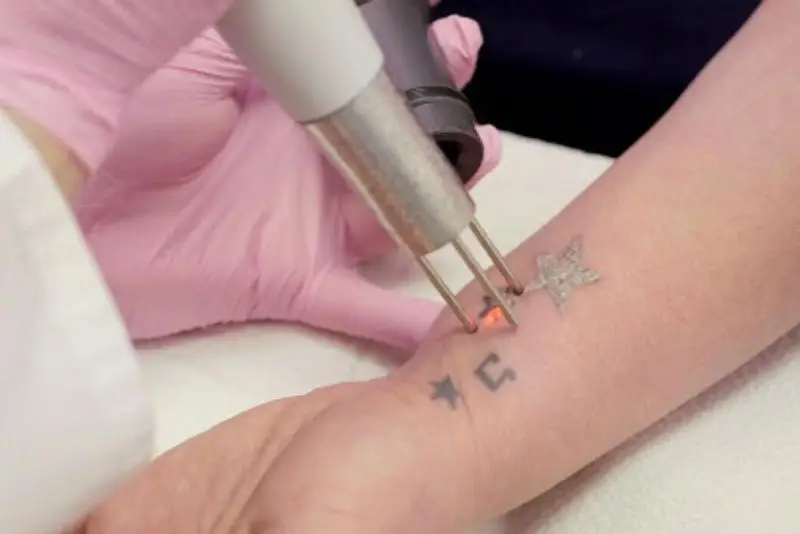 Không cạy lớp vảy xóa xăm