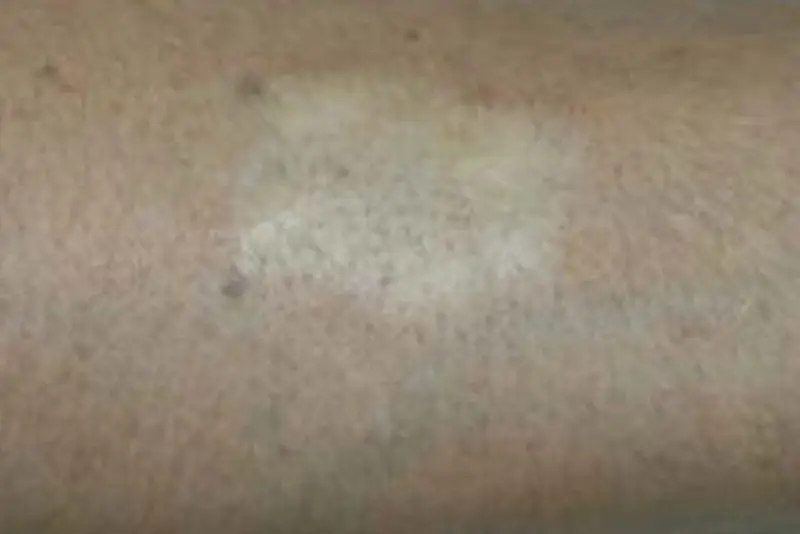 Da có thể bị tăng hoặc giảm sắc tố sau khi xóa xăm