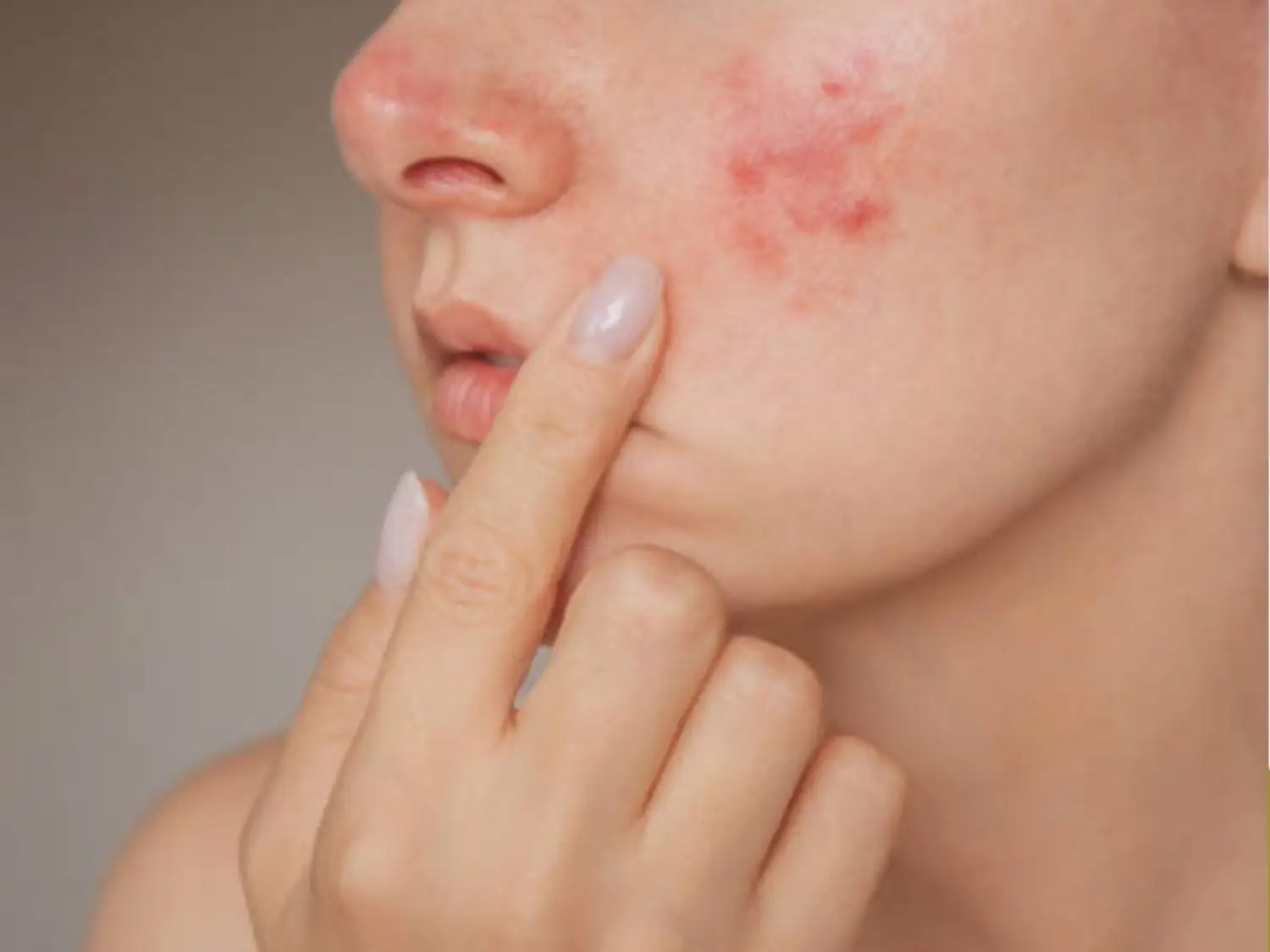 Đang bị mụn viêm nặng, mụn mủ không nên triệt lông mặt