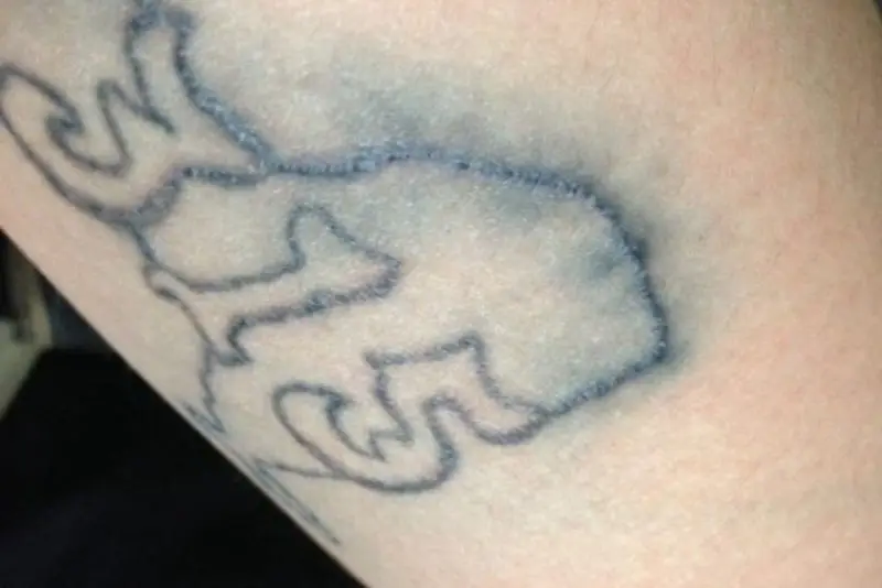 Nổ mực hình xăm gây loang màu