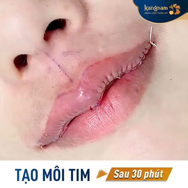 Cắt môi trái tim giúp tạo hình môi trên thành dáng trái tim cân đối