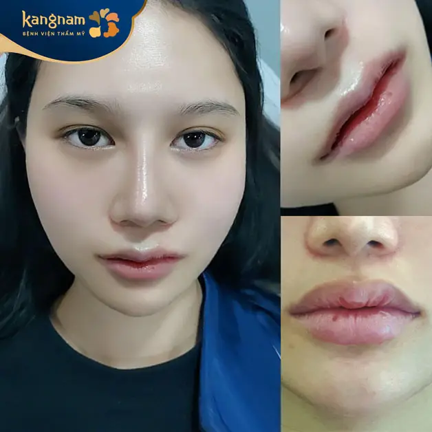 Khách hàng cắt môi tim tại Kangnam sở hữu đôi môi tự nhiên