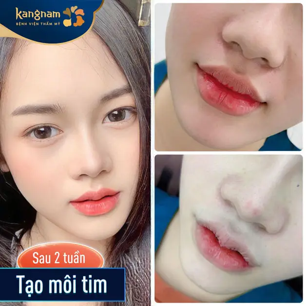 Môi có thể sưng nhẹ sau phẫu thuật nhưng sẽ giảm sau vài ngày
