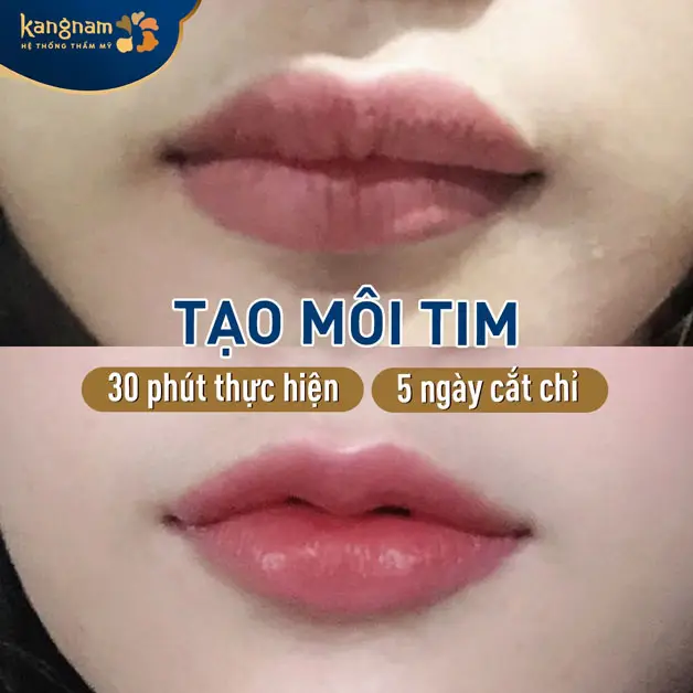 Cắt môi trái tim cắt chỉ sau khi vết khâu đủ ổn định