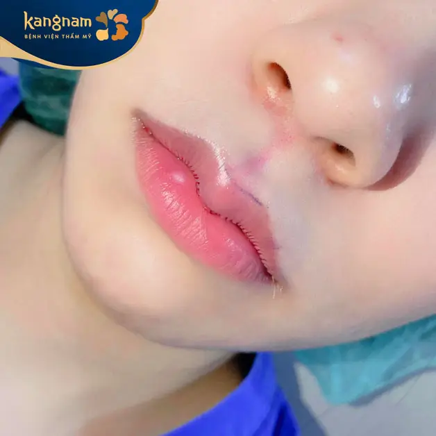 Vết mổ lành nhanh, không sẹo