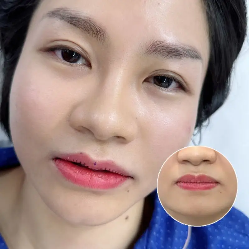 Môi vừa phẫu thuật sẽ hơi cứng, tuy nhiên sẽ cải thiện dần sau khi hồi phục