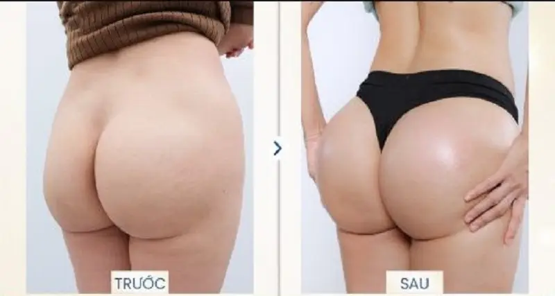 Túi nâng mông có độ tương thích cao với cơ thể