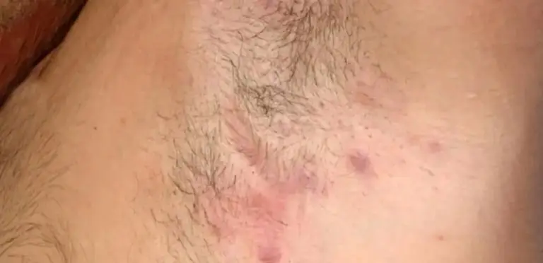 Viêm nang lông khiến da sưng đỏ