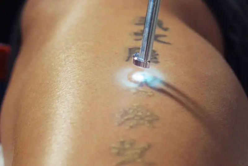 chưa có công nghệ nào có thể đảm bảo xóa sạch hình xăm chỉ sau một lần thực hiện mà không gây tổn thương cho da